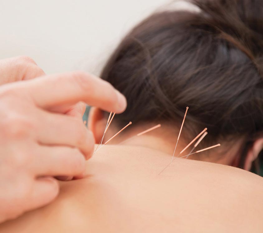 Chronic Muscle Pain - Acupuncture 